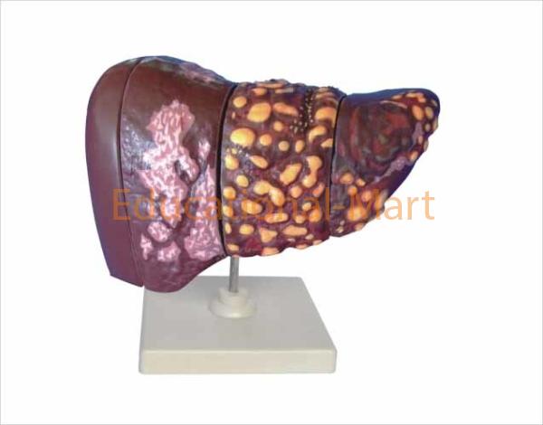 Disease Liver Model