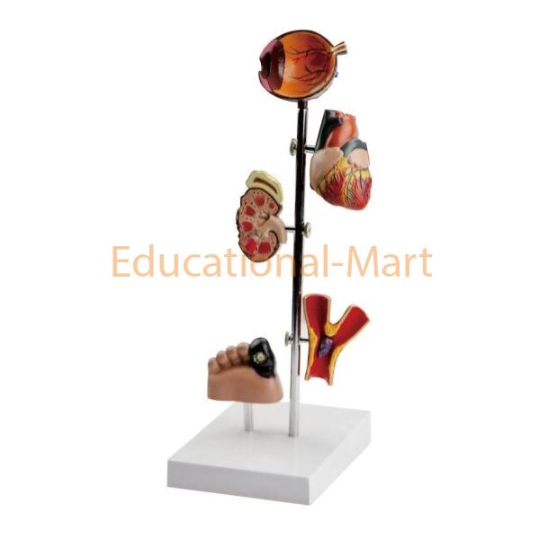Hypertension Model 5-parts