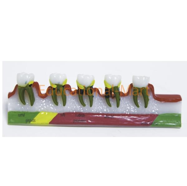 Model of Decayed Teeth