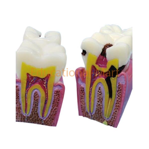 Model of Decayed Tooth