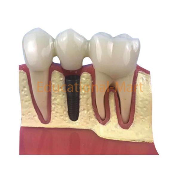 Model of Dental lmplant