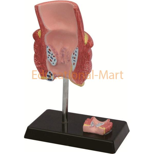 Model of Hemorrhoid